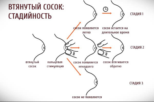 Плоские и втянутые соски